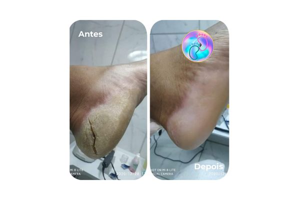 Foto de antes e depois do tratamento 5